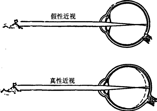 戴眼鏡會(huì)讓眼睛近視度數(shù)加深？