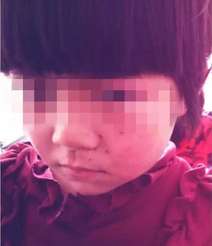 10+9沒算好 鄭州6歲女童小臉被“老師”扎6個(gè)洞