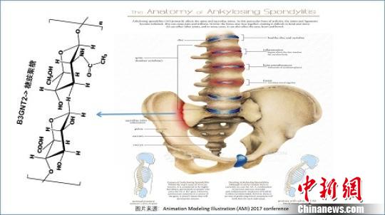 中國科學(xué)家等揭示漢族人群強(qiáng)直性脊柱炎關(guān)聯(lián)基因